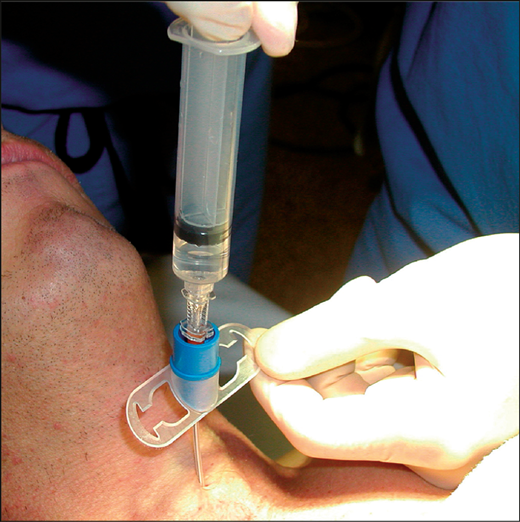 Needle cricothyrotomy: from Gulleth Y, Spiro J. Percutaneous Transtracheal Jet Ventilation in Head and Neck Surgery. Arch Otolaryngol Head Neck Surg. 2005;131(10):886–890. doi:10.1001/archotol.131.10.886
